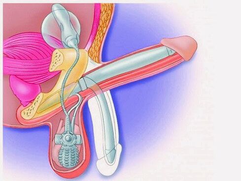 Paglaki ng ari sa pamamagitan ng prosthesis ng penile